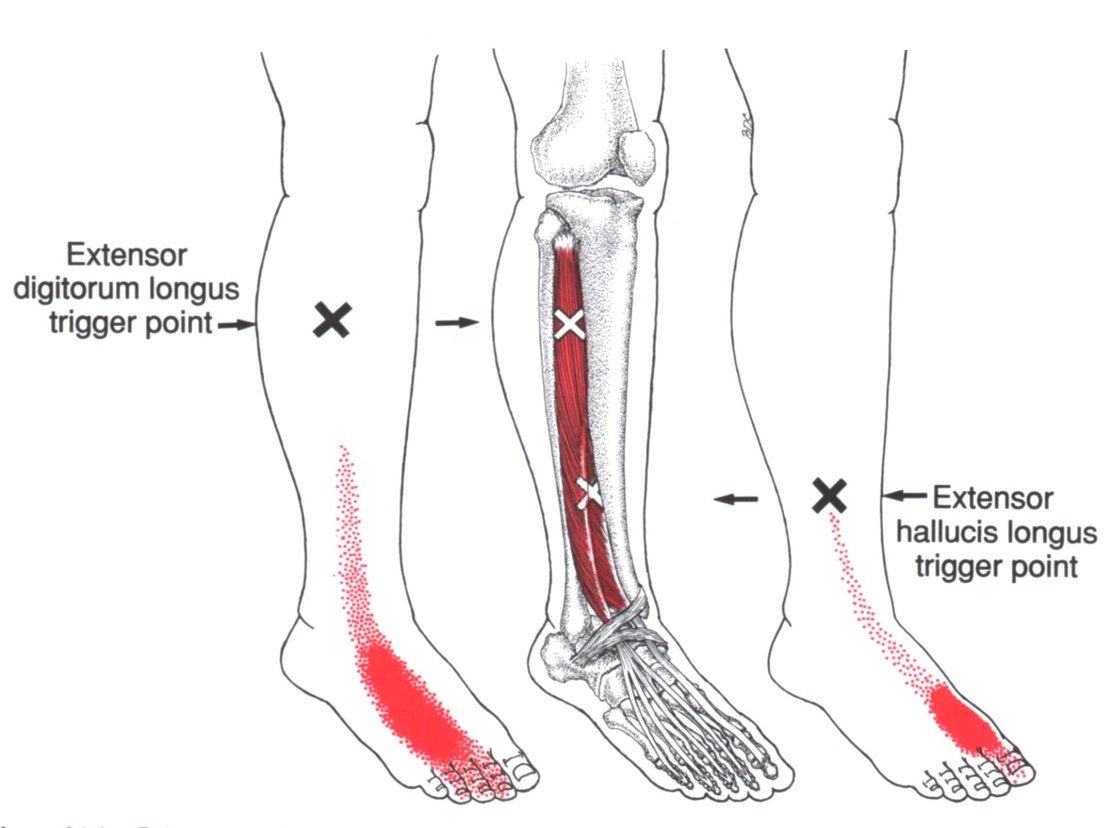 Langer Streckmuskel Unterschenkelfuß The Trigger Point And Referred